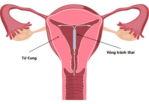 Đặt vòng tránh thai 